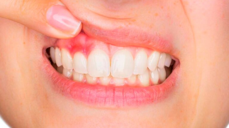 El sangrado recurrente durante el cepillado puede indicar inflamación de las encías y debe ser valorado por un profesional de la salud oral.
